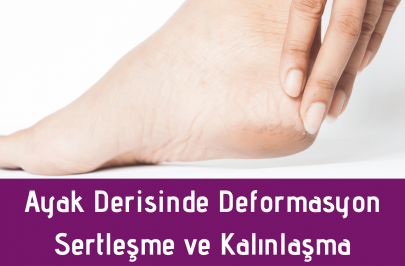 ayak-derisinde-deformasyon-sertlesme-ve-kalinlasma